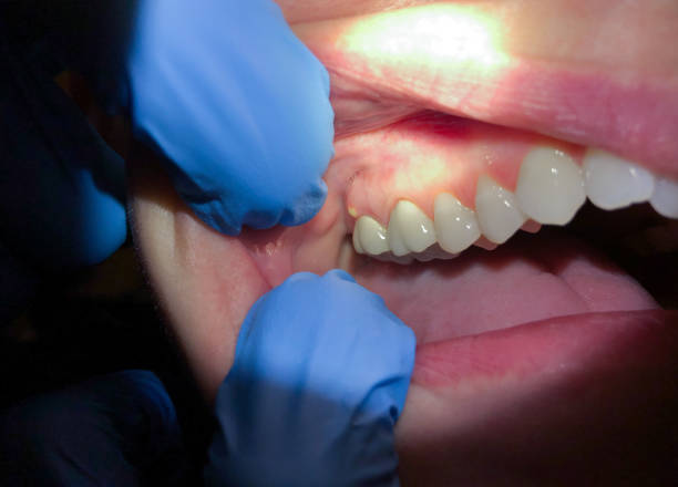 Best Emergency Tooth Extraction in Lewiston, CA